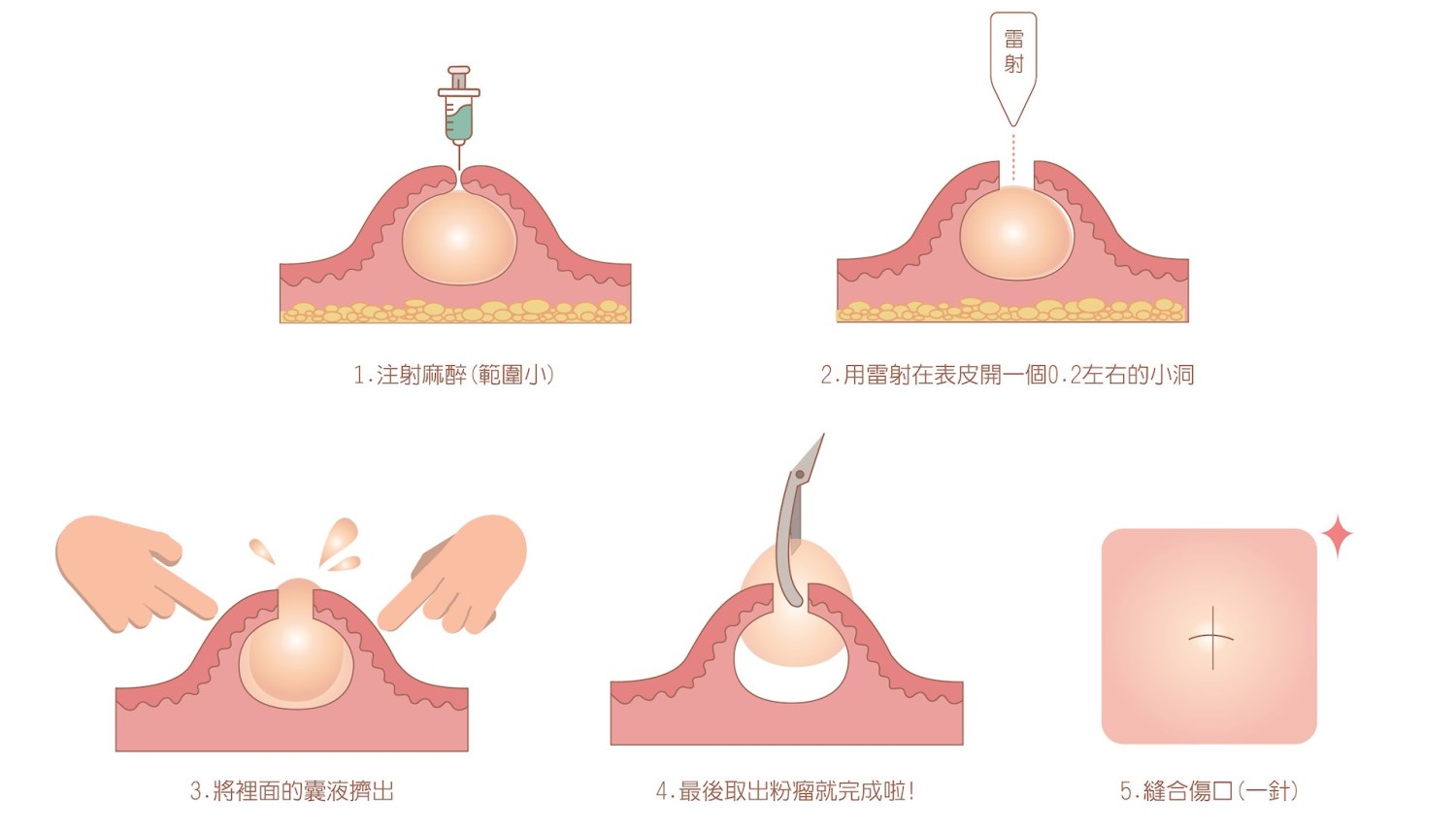 粉瘤 台中粉瘤 粉瘤手術 微創粉瘤 皮膚科 微創手術 文心極緻皮膚科診所 疤痕 