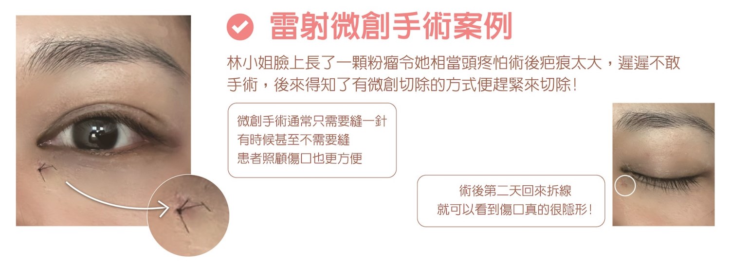 粉瘤 台中粉瘤 粉瘤手術 微創粉瘤 皮膚科 微創手術 文心極緻皮膚科診所 疤痕 